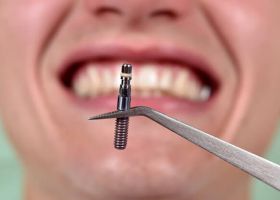 dental-implants-service-ho-chi-minh-city-dental-clinic-dr-cuong-2058.jpg