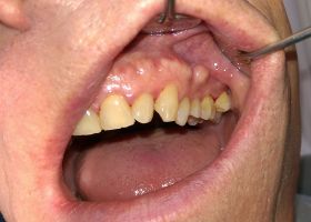 loixuonghamtrenexostosis-7166.jpg